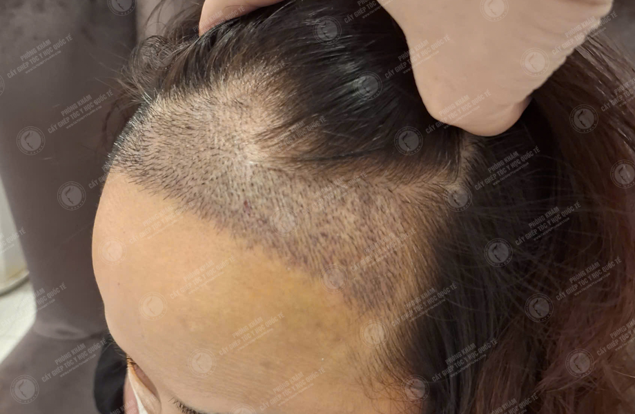 Trịnh Thanh Nga - Cấy tóc tự thân 9