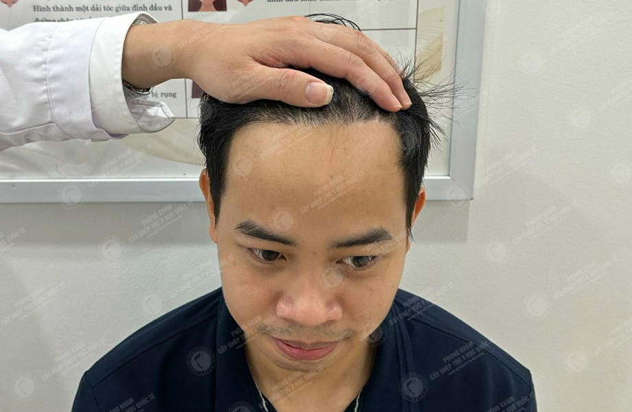 Lý Tùng Thanh - Cấy tóc đường chữ M 9