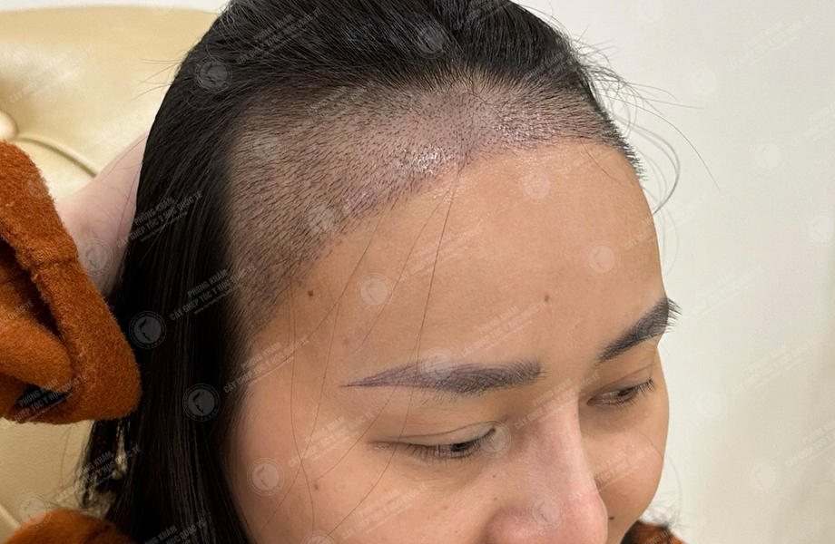 Đỗ Thị Thu Trang - Cấy tóc đường chữ M 9