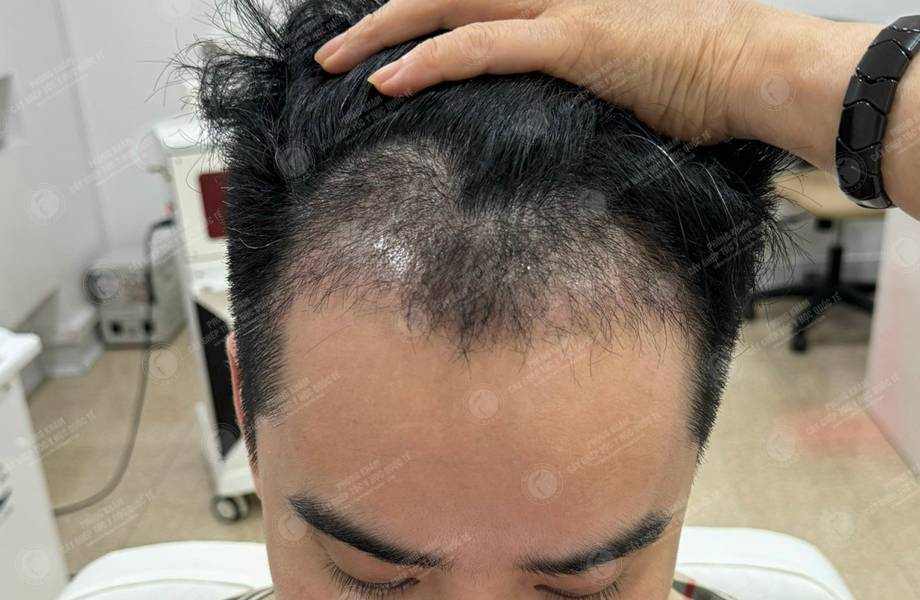 Vi Văn Tam - Cấy tóc đường chữ M 9