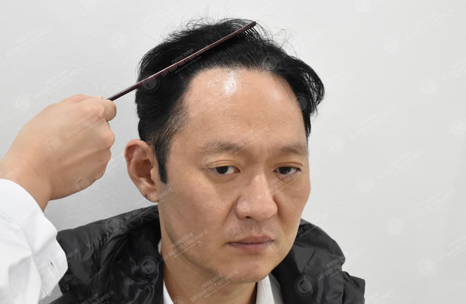 Han Seongmin - Cấy tóc đường chữ M 7