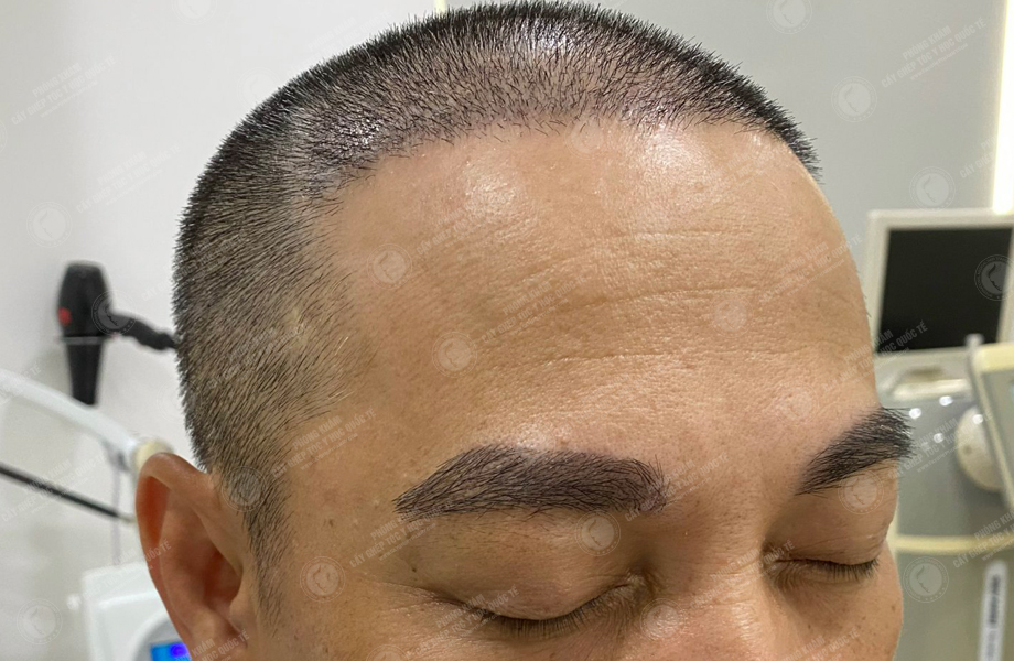 Trần Vinh Sơn - Cấy lông mày 9