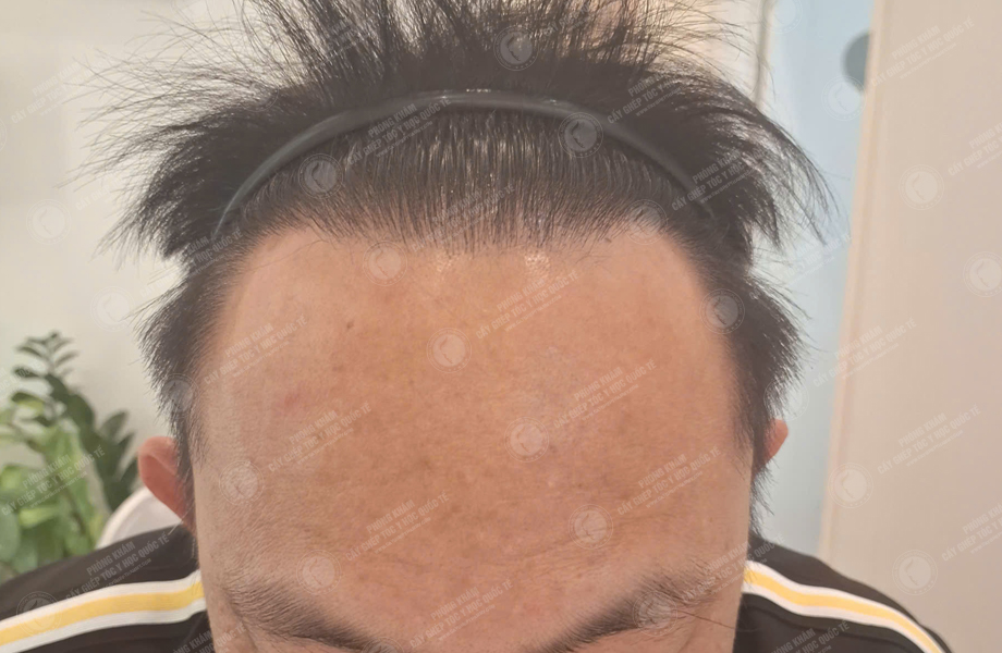 Nguyễn Hữu Huân - Cấy tóc đường chữ M 9