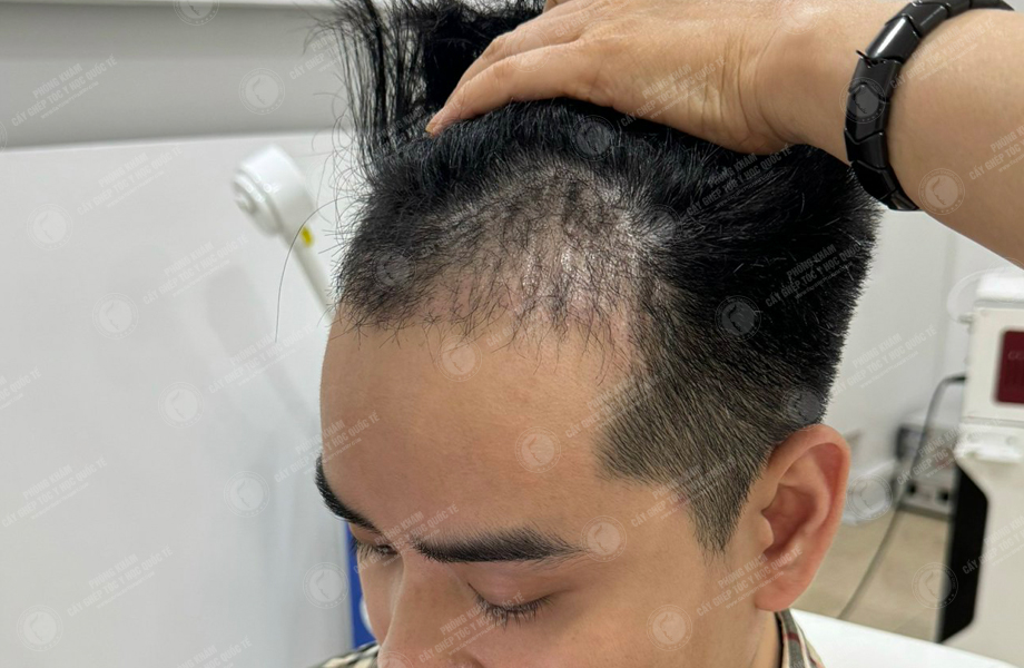 Vi Văn Tam - Cấy tóc đường chữ M 10