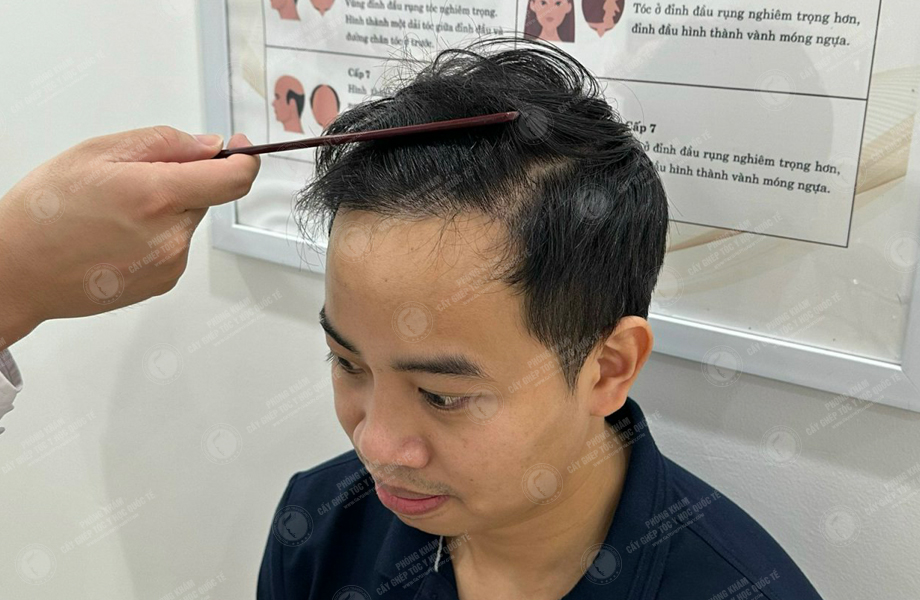 Lý Tùng Thanh - Cấy tóc đường chữ M 10