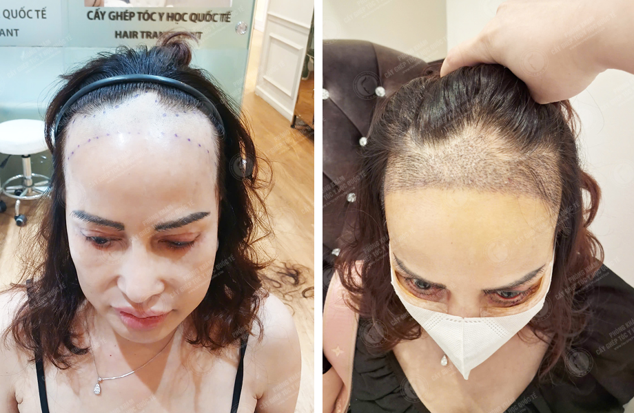  Trịnh Thanh Nga - Cấy tóc tự thân 1
