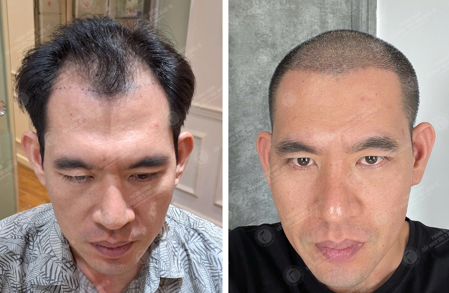  Dương Văn Tiến - Cấy tóc tự thân 1