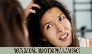 Da đầu ngứa và có gàu rụng tóc: nguyên nhân và cách điều trị