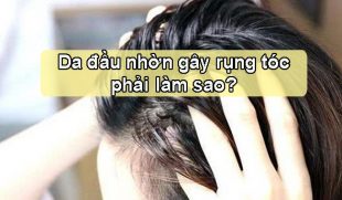 Da đầu nhờn gây rụng tóc khắc phục như thế nào?