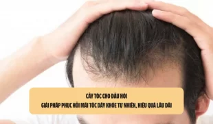 Cấy tóc cho đầu hói: Giải pháp phục hồi mái tóc dày khỏe tự nhiên, hiệu quả lâu dài
