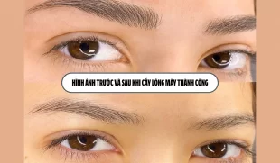 Hình ảnh trước và sau khi cấy lông mày thành công