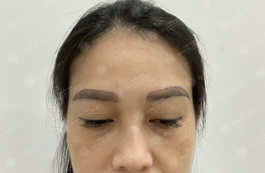 Phạm Thị Ánh - Cấy lông mày 4