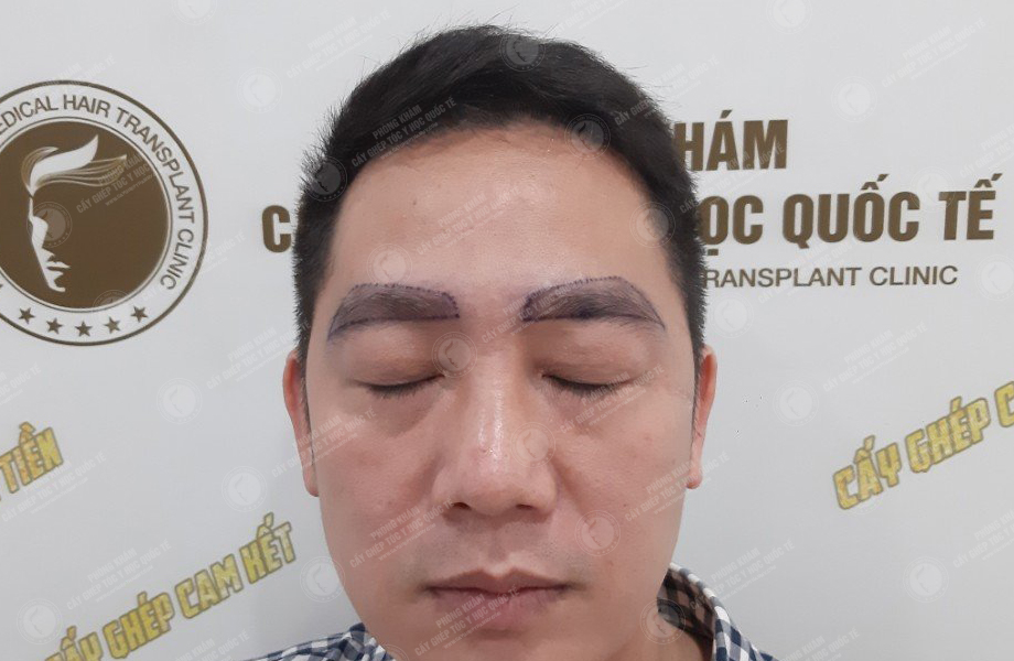 Trịnh Ngọc Hưng - Cấy lông mày 2