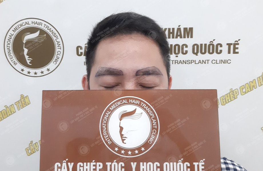 Trịnh Ngọc Hưng - Cấy lông mày 3