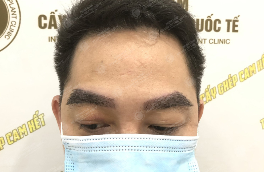 Trịnh Ngọc Hưng - Cấy lông mày 4
