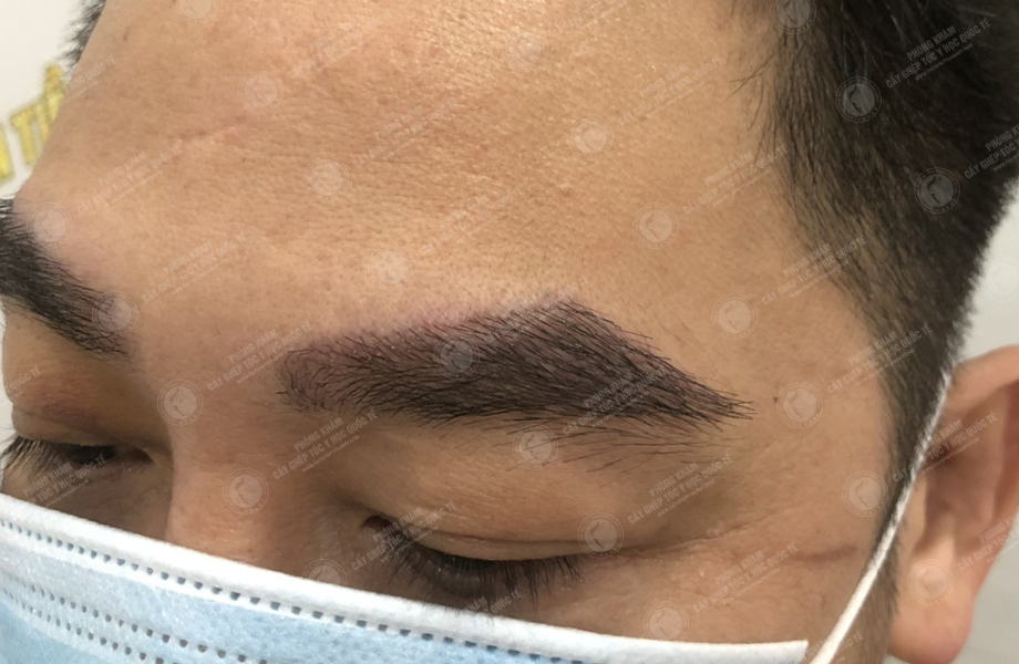 Trịnh Ngọc Hưng - Cấy lông mày 5
