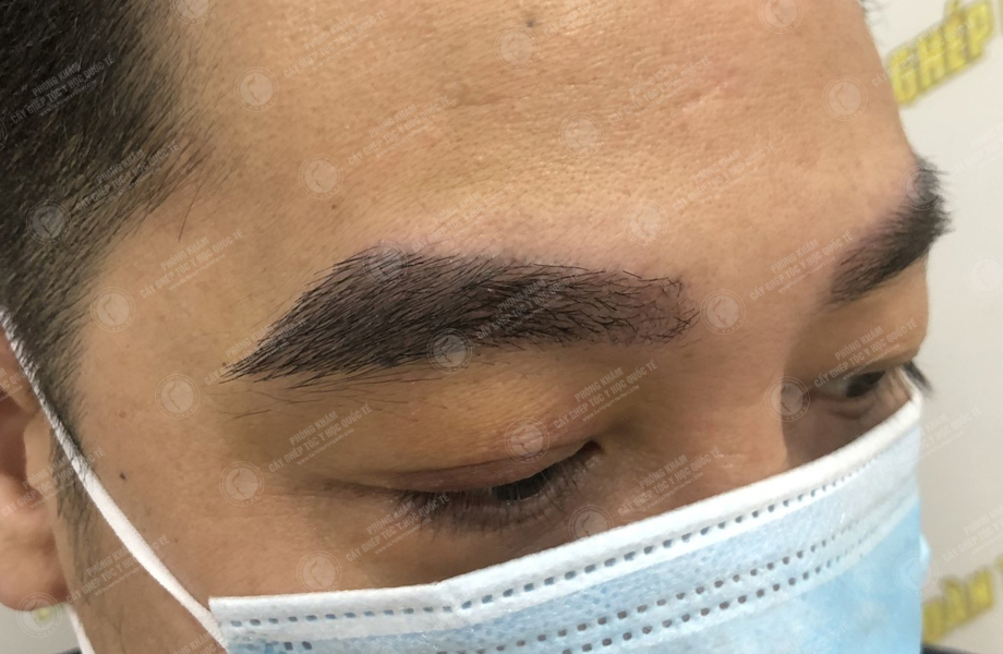 Trịnh Ngọc Hưng - Cấy lông mày 6