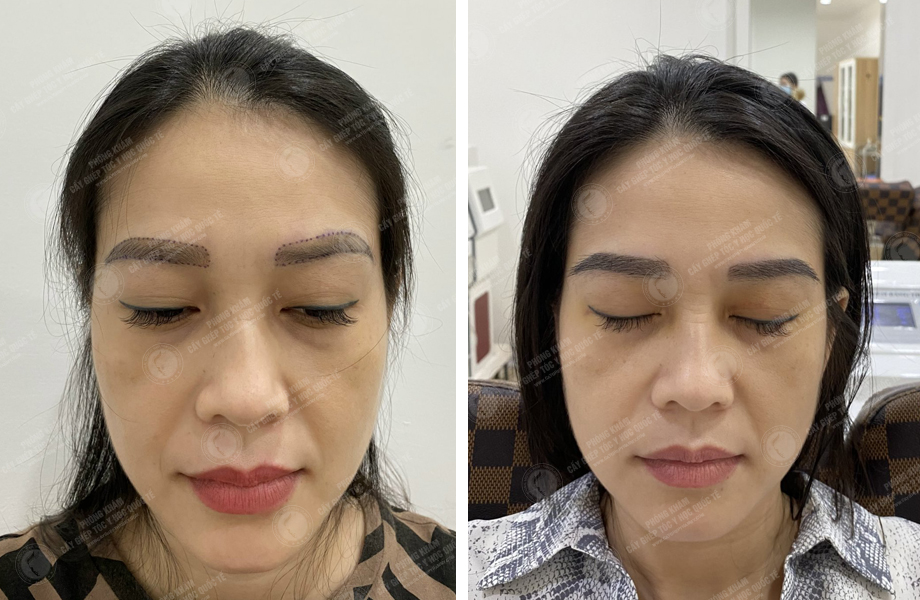  Phạm Thị Ánh - Cấy lông mày 1