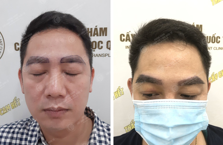  Trịnh Ngọc Hưng - Cấy lông mày 1