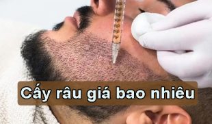 Cấy râu giá bao nhiêu? Cập nhật giá cấy râu mới nhất