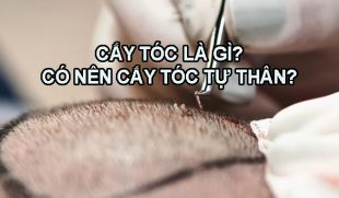 Cấy tóc là gì? Có nên cấy tóc tự thân hay không?