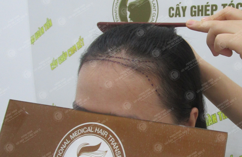 Lê Thị Mai - Cấy tóc trên sẹo 2