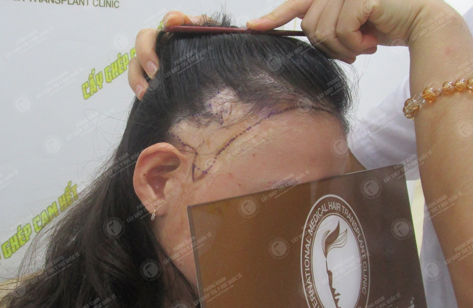 Lê Thị Mai - Cấy tóc trên sẹo 3