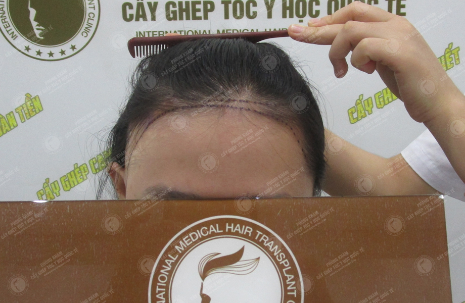 Lê Thị Mai - Cấy tóc trên sẹo 4