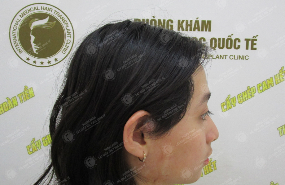 Lê Thị Mai - Cấy tóc trên sẹo 6