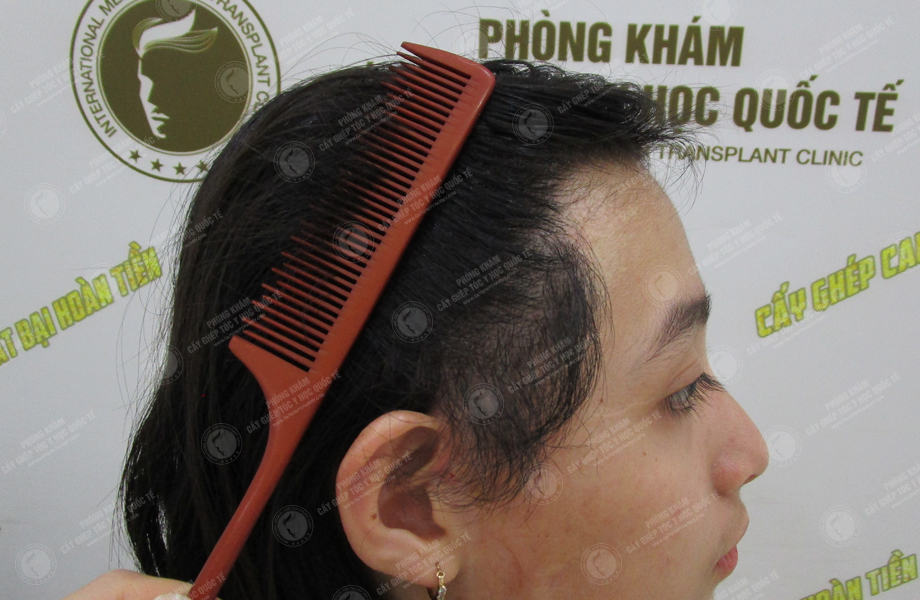 Lê Thị Mai - Cấy tóc trên sẹo 7
