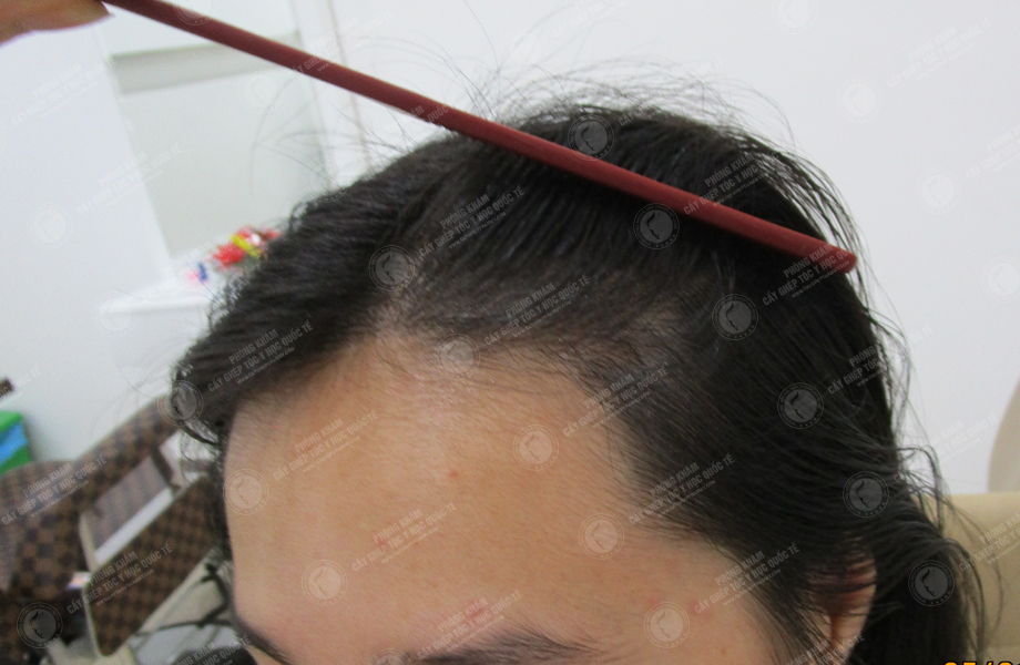 Lê Thị Mai - Cấy tóc trên sẹo 8
