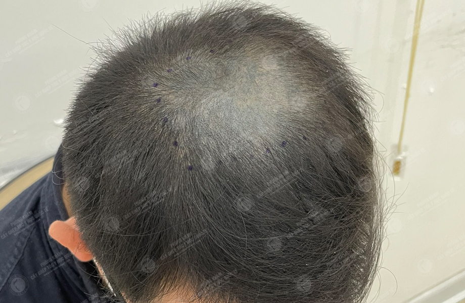 Nguyễn Trung Khanh - Cấy tóc tự thân 2