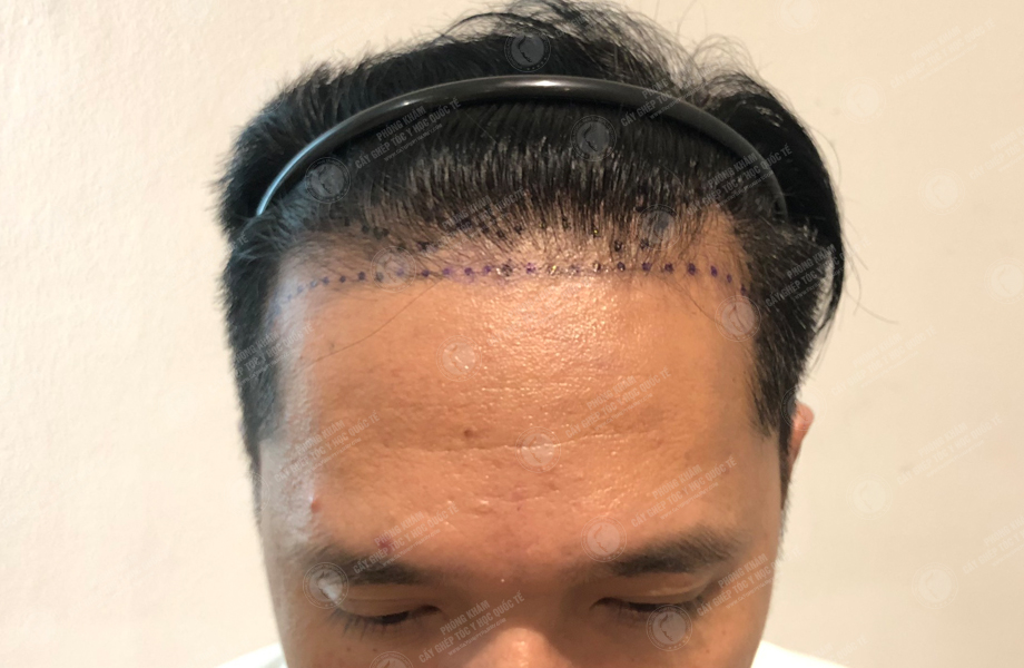 Đinh Thành Công - Cấy tóc đường chữ M 2