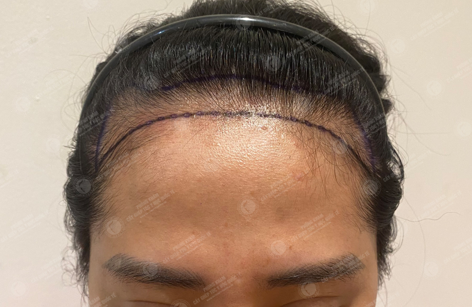 Đào Lan  Phương - Cấy tóc đường chữ M 2