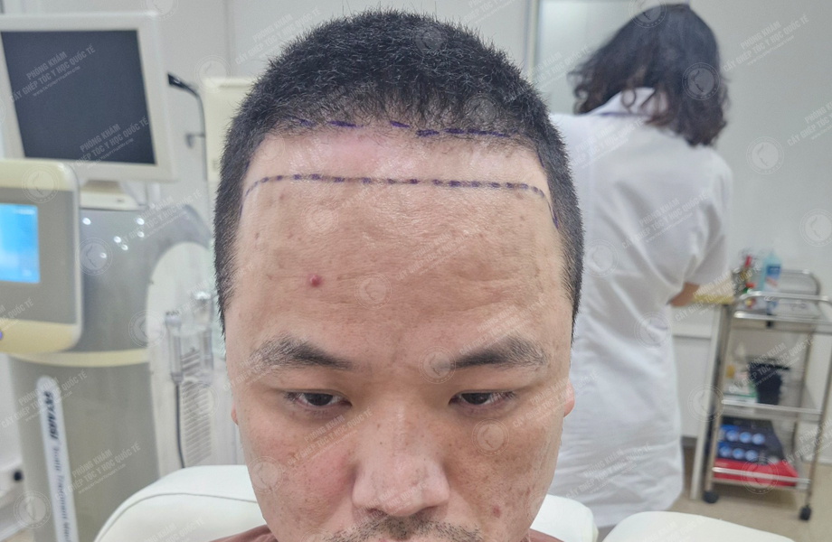 Lê Việt Hoàng - Cấy tóc đường chữ M 2
