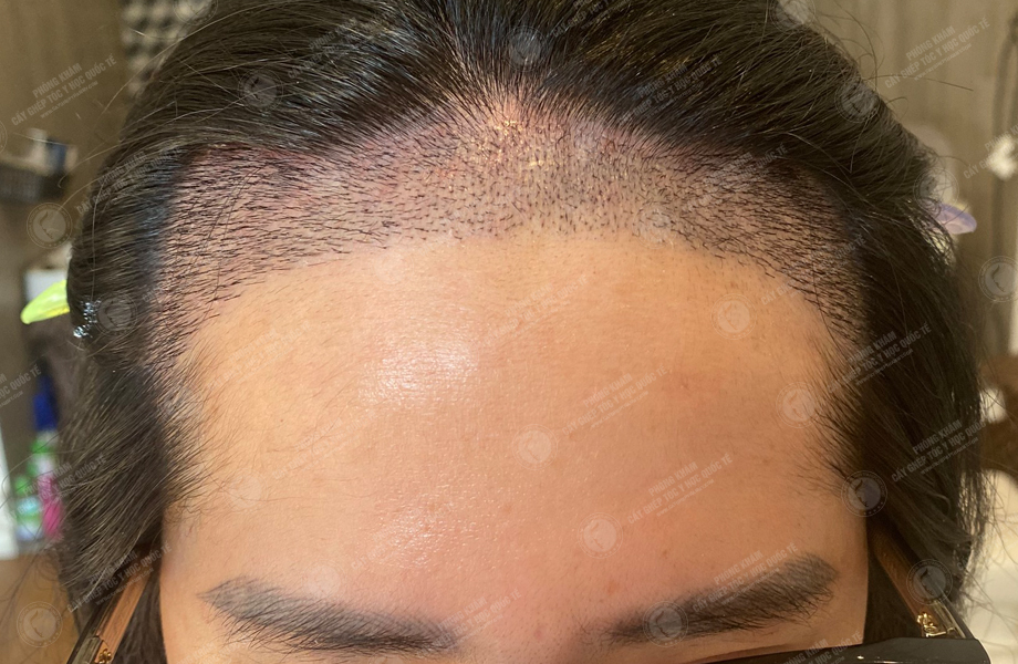 Đào Lan  Phương - Cấy tóc đường chữ M 4