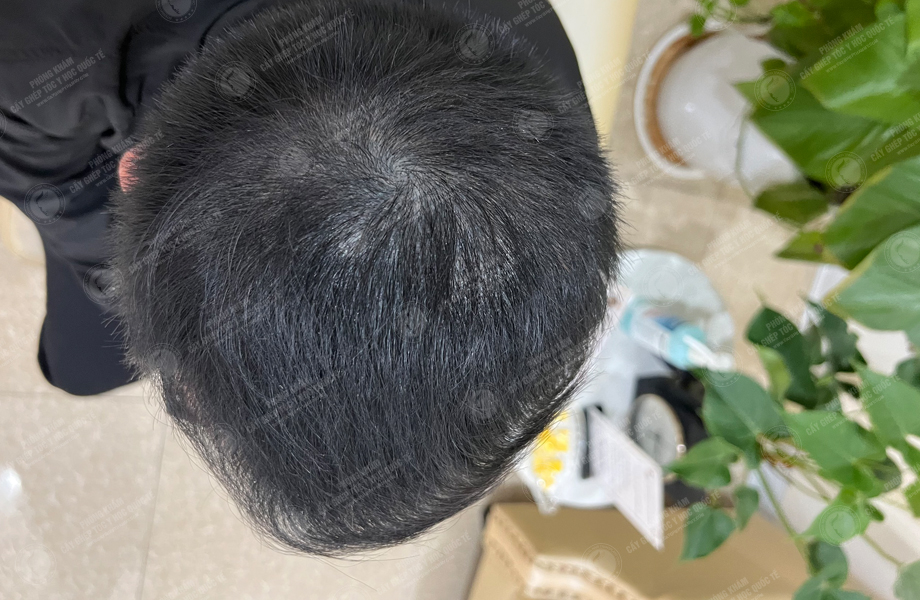 Nguyễn Trung Khanh - Cấy tóc tự thân 6