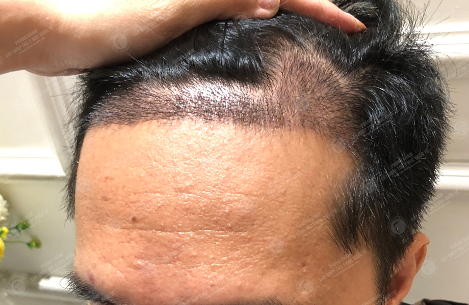 Đinh Thành Công - Cấy tóc đường chữ M 6