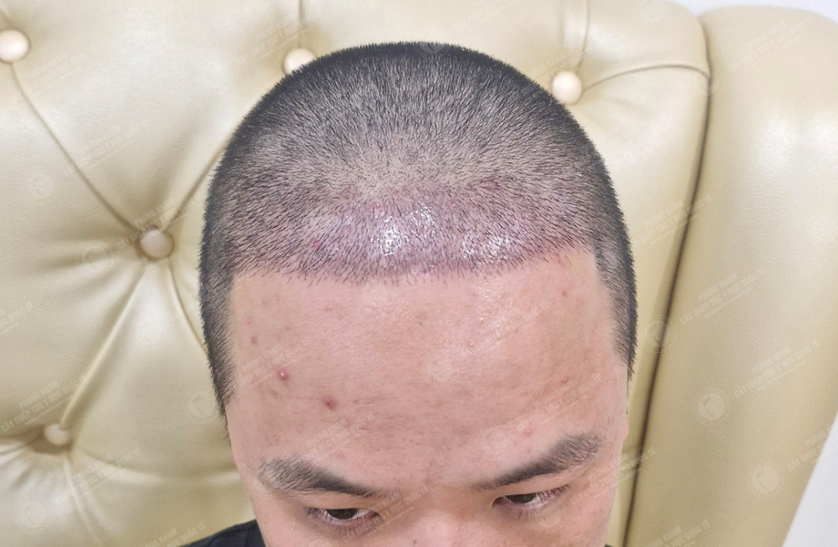 Lê Việt Hoàng - Cấy tóc đường chữ M 6