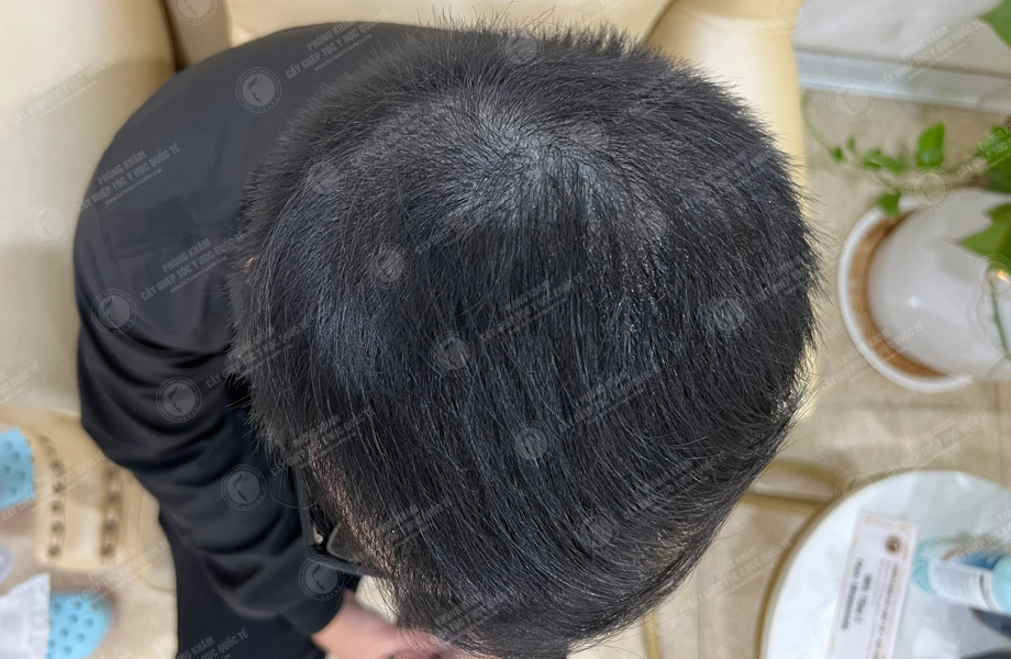 Nguyễn Trung Khanh - Cấy tóc tự thân 7