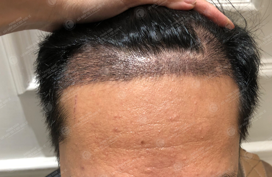 Đinh Thành Công - Cấy tóc đường chữ M 7