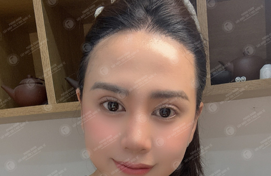 Đào Lan  Phương - Cấy tóc đường chữ M 7