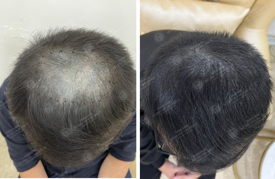  Nguyễn Trung Khanh - Cấy tóc tự thân 1