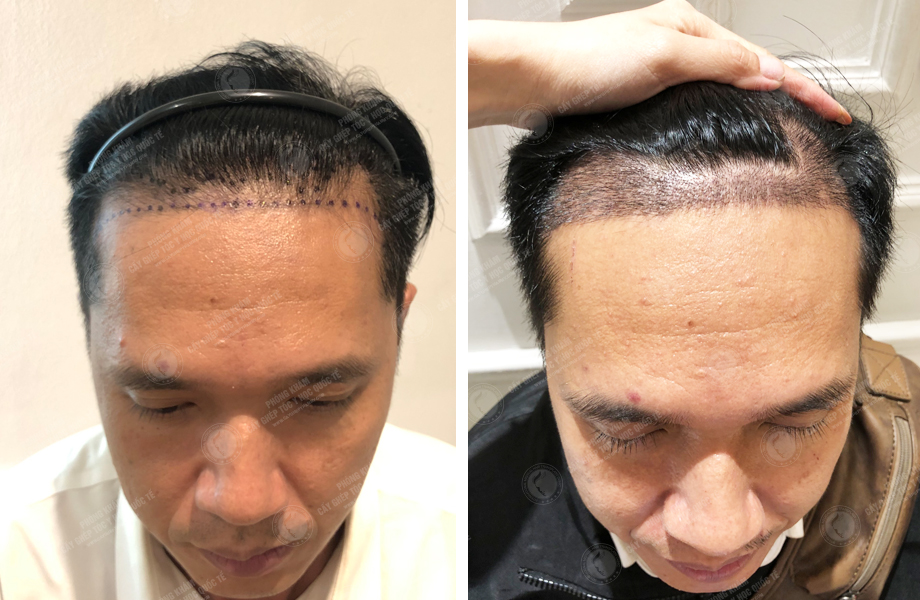  Đinh Thành Công - Cấy tóc tự thân 1