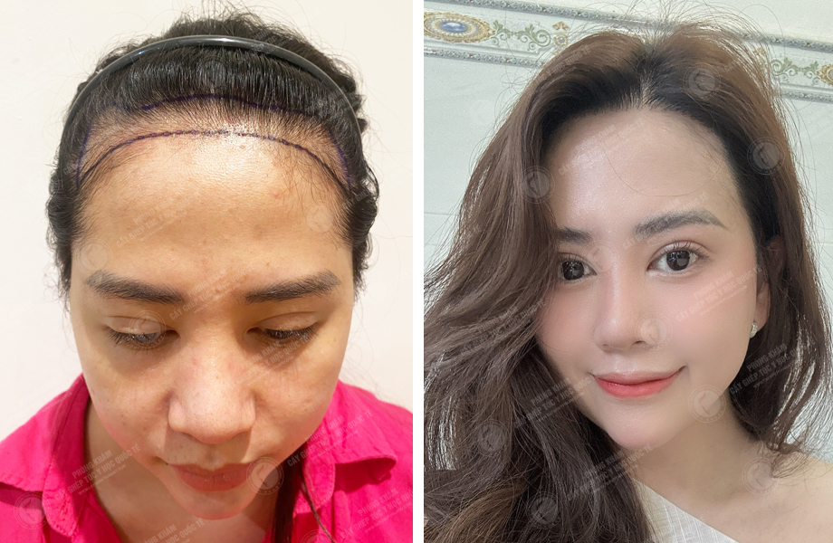  Đào Lan  Phương - Cấy tóc đường chữ M 1