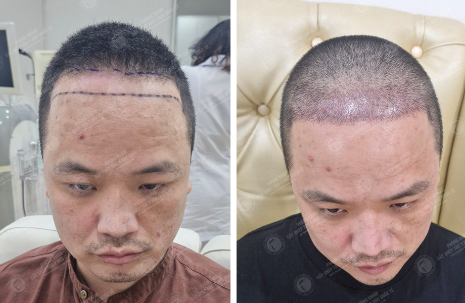  Lê Việt Hoàng - Cấy tóc đường chữ M 1