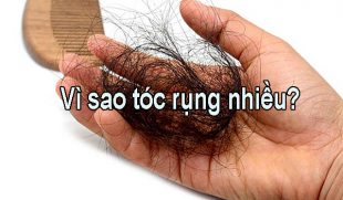 Vì sao tóc rụng nhiều và phương hướng điều trị dứt điểm
