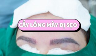 Tất tần tật về cấy lông mày bị sẹo: Quy trình, chi phí và địa chỉ