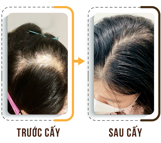 cấy tóc trị hói