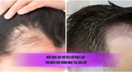 Mất bao lâu thì tóc cấy mọc lại? Tìm hiểu chu trình mọc tóc sau cấy